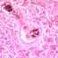 Cole-Parmer Prepared Slide, Human Lung Tissue, Diseased Cole-Parmer Prepared Slide, Human Lung Tissue, Diseased