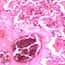 Cole-Parmer Prepared Slide, Human Lung Tissue, Diseased Cole-Parmer Prepared Slide, Human Lung Tissue, Diseased