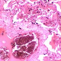 Cole-Parmer Prepared Slide, Human Lung Tissue, Diseased