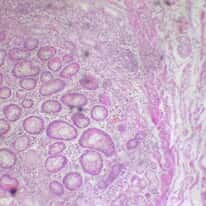 Cole-Parmer Prepared Slide, Human Stomach Tissue, Ulcer Cells